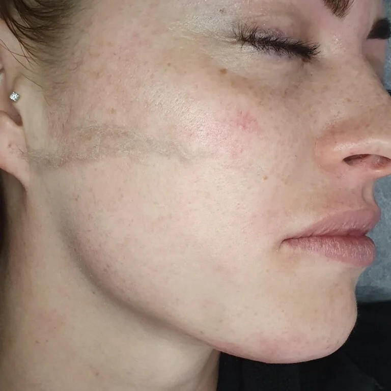 dermaplaning-768x946