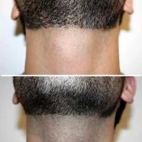 mens-laser