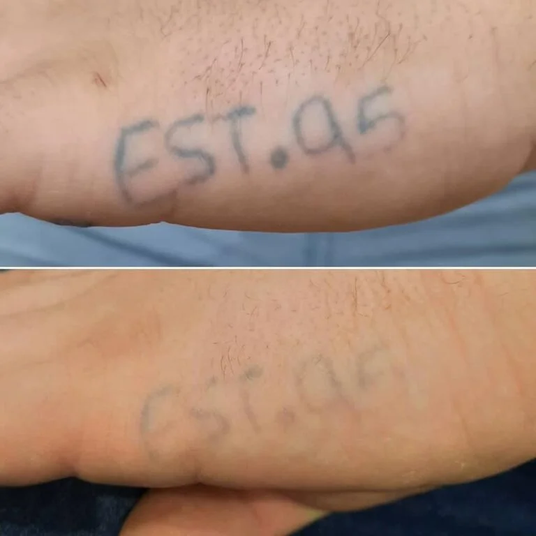 tattoo-removal-2-768x768