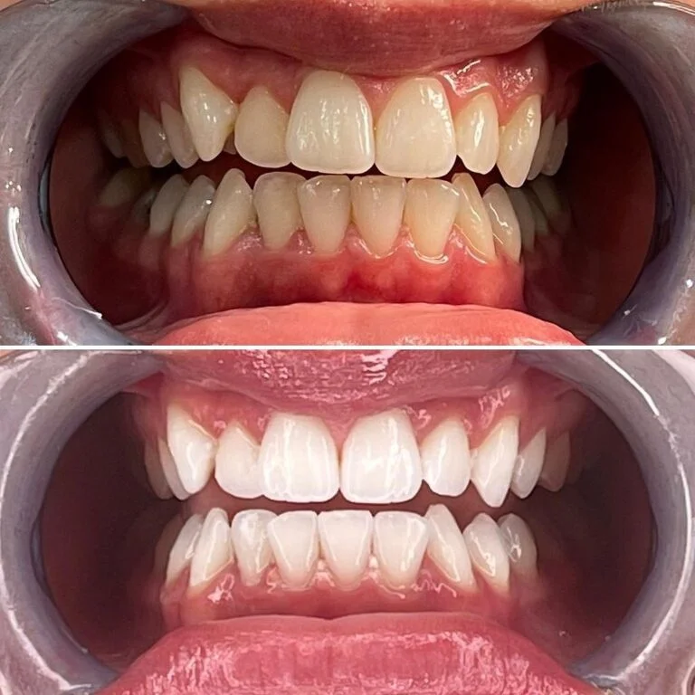 teeth-whitening-768x768